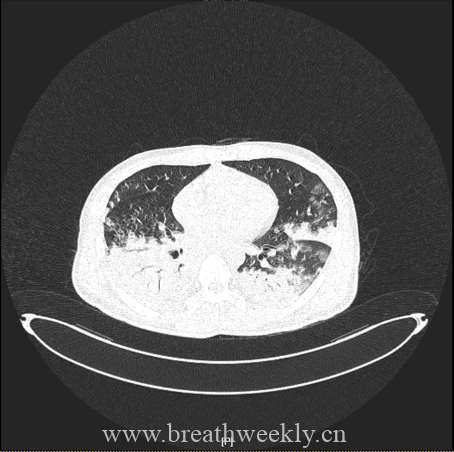 图片[18]-病例67 | 每周呼吸-每周呼吸