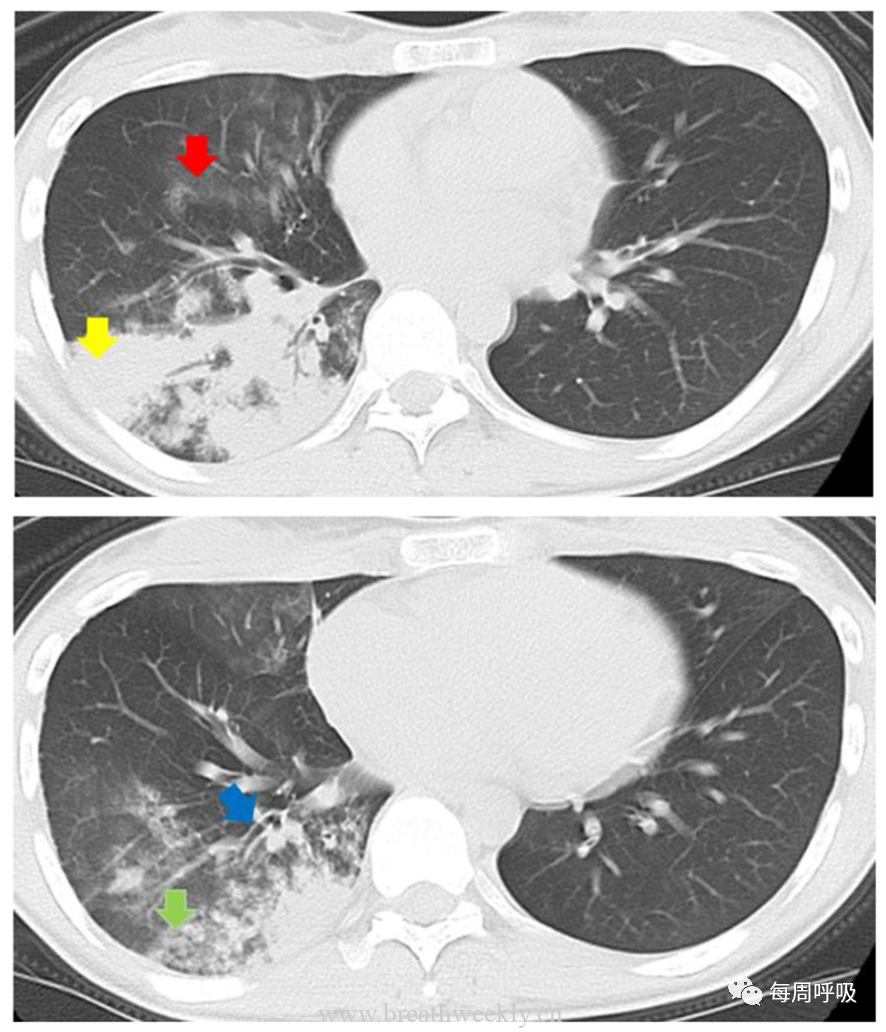 图片[15]-肺炎支原体肺炎病理与影像相关性 | 每周呼吸-每周呼吸