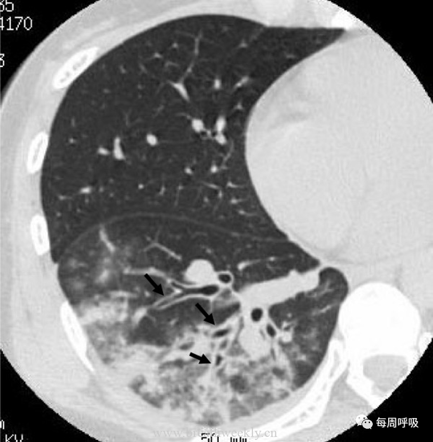 图片[16]-肺炎支原体肺炎病理与影像相关性 | 每周呼吸-每周呼吸