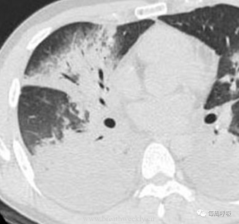 图片[18]-肺炎支原体肺炎病理与影像相关性 | 每周呼吸-每周呼吸