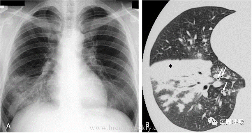 图片[8]-肺炎支原体肺炎病理与影像相关性 | 每周呼吸-每周呼吸