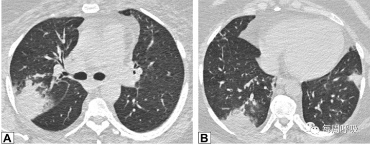 图片[10]-CHEST综述：机化性肺炎的诊断流程（临床-影像-病理特征相关性） | 每周呼吸-每周呼吸