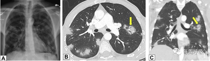 图片[11]-CHEST综述：机化性肺炎的诊断流程（临床-影像-病理特征相关性） | 每周呼吸-每周呼吸
