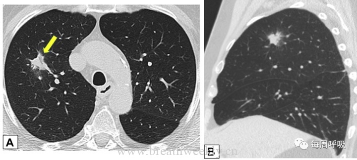 图片[12]-CHEST综述：机化性肺炎的诊断流程（临床-影像-病理特征相关性） | 每周呼吸-每周呼吸