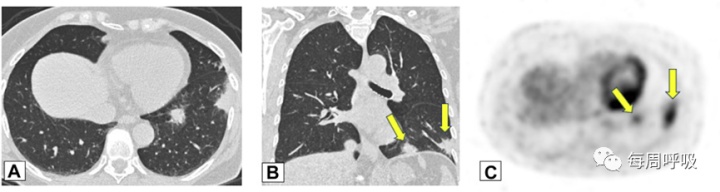 图片[13]-CHEST综述：机化性肺炎的诊断流程（临床-影像-病理特征相关性） | 每周呼吸-每周呼吸