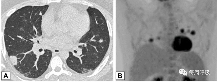 图片[14]-CHEST综述：机化性肺炎的诊断流程（临床-影像-病理特征相关性） | 每周呼吸-每周呼吸
