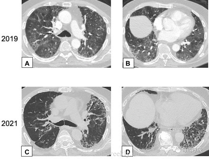 图片[17]-CHEST综述：机化性肺炎的诊断流程（临床-影像-病理特征相关性） | 每周呼吸-每周呼吸