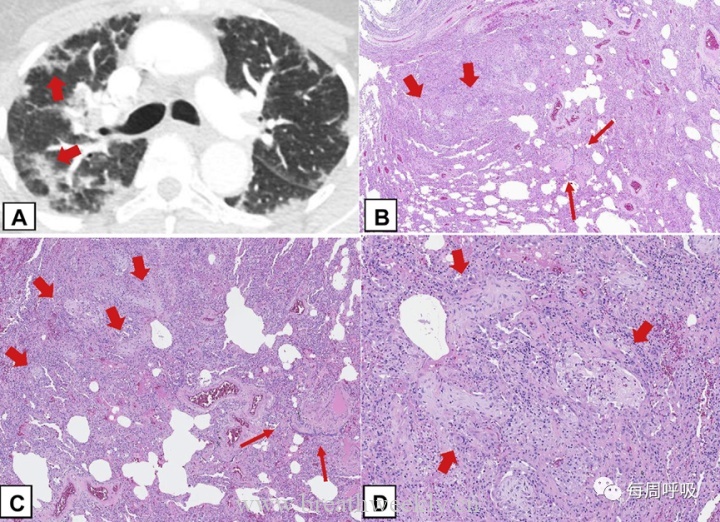 图片[21]-CHEST综述：机化性肺炎的诊断流程（临床-影像-病理特征相关性） | 每周呼吸-每周呼吸