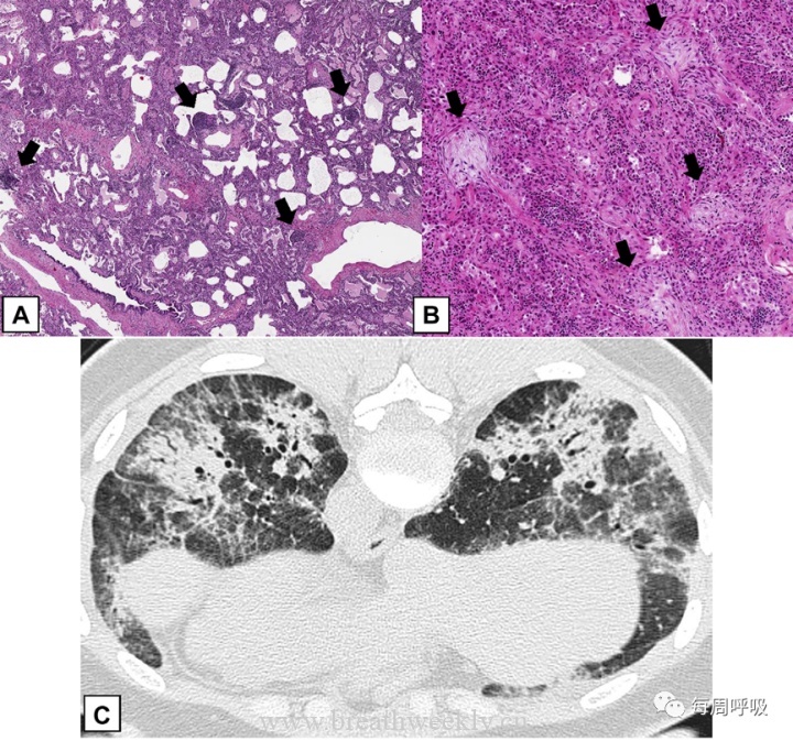 图片[22]-CHEST综述：机化性肺炎的诊断流程（临床-影像-病理特征相关性） | 每周呼吸-每周呼吸