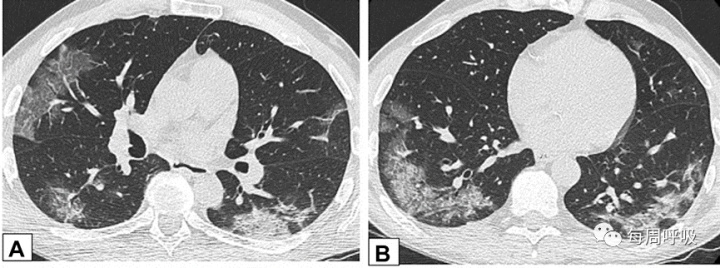 图片[27]-CHEST综述：机化性肺炎的诊断流程（临床-影像-病理特征相关性） | 每周呼吸-每周呼吸