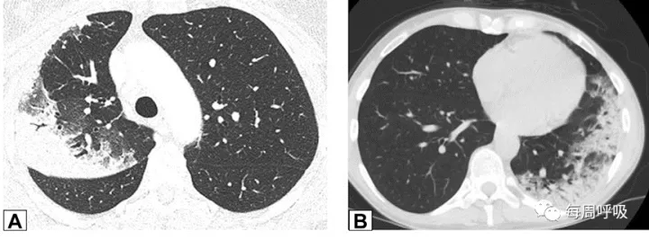 图片[2]-CHEST综述：机化性肺炎的诊断流程（临床-影像-病理特征相关性） | 每周呼吸-每周呼吸
