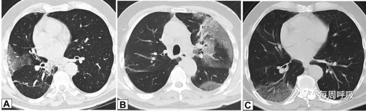 图片[5]-CHEST综述：机化性肺炎的诊断流程（临床-影像-病理特征相关性） | 每周呼吸-每周呼吸