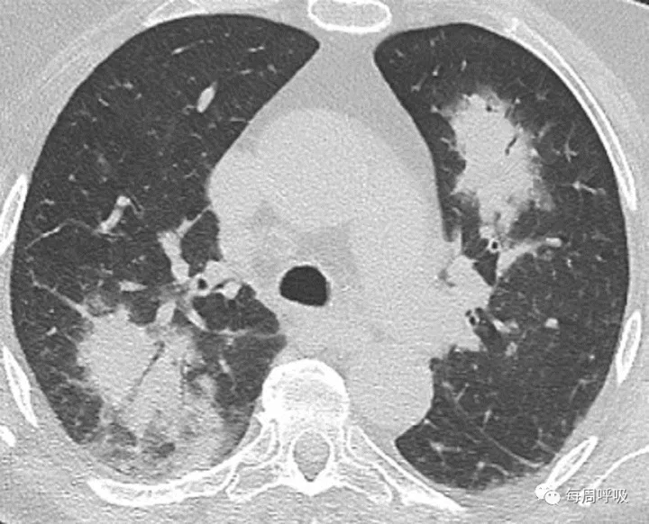 图片[6]-CHEST综述：机化性肺炎的诊断流程（临床-影像-病理特征相关性） | 每周呼吸-每周呼吸