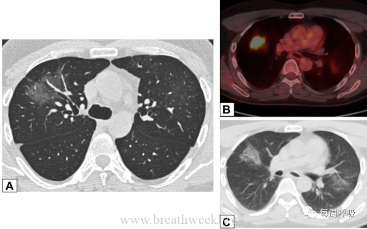 图片[7]-CHEST综述：机化性肺炎的诊断流程（临床-影像-病理特征相关性） | 每周呼吸-每周呼吸
