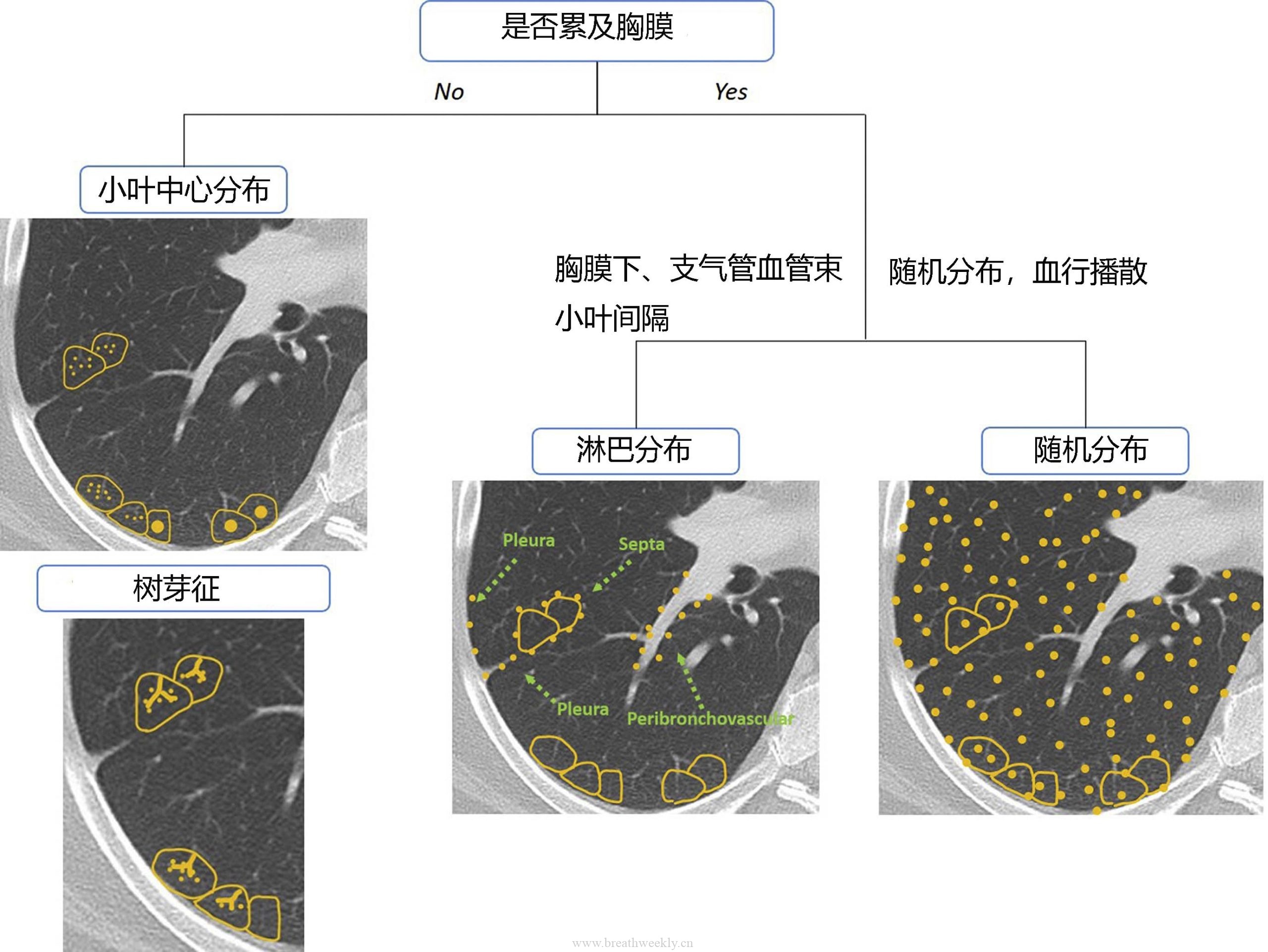 图片[2]-HRCT基础 | 每周呼吸-每周呼吸