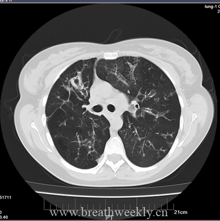 图片[2]-每周病例 | 每周呼吸-每周呼吸