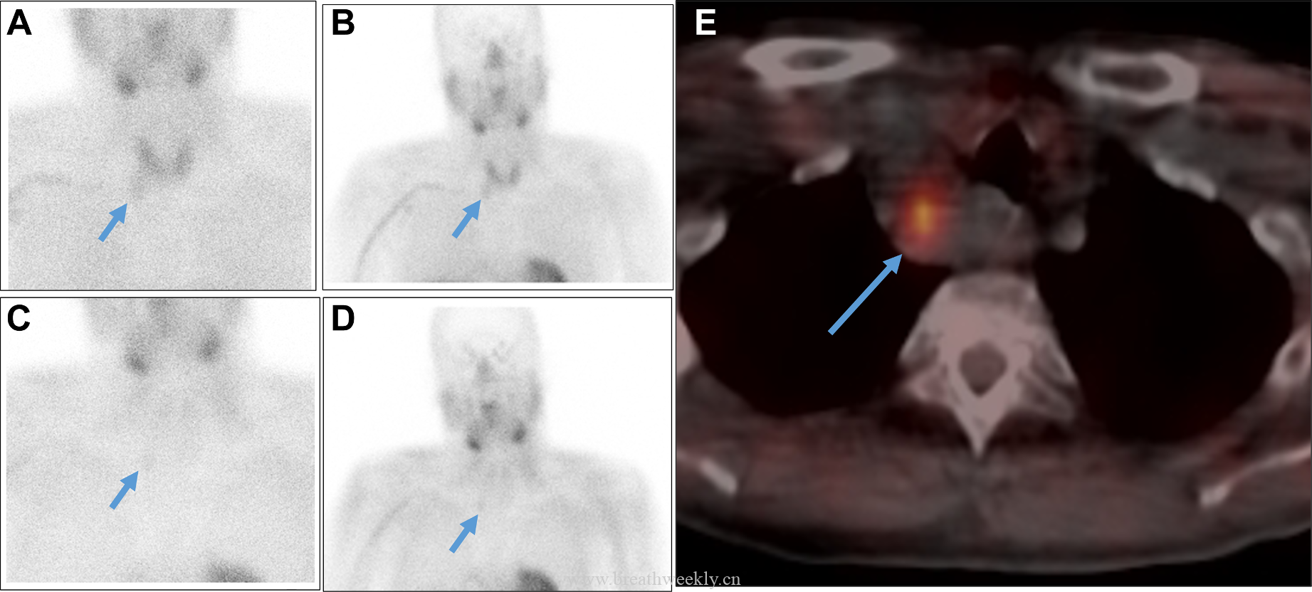 图2 Sestamibi显像