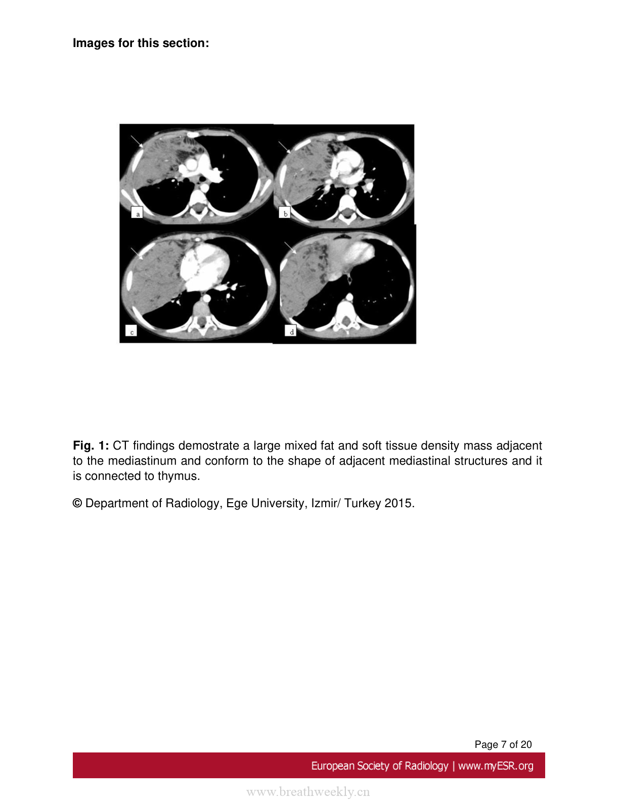 胸部含脂肪病变的影像学鉴别诊断-每周呼吸