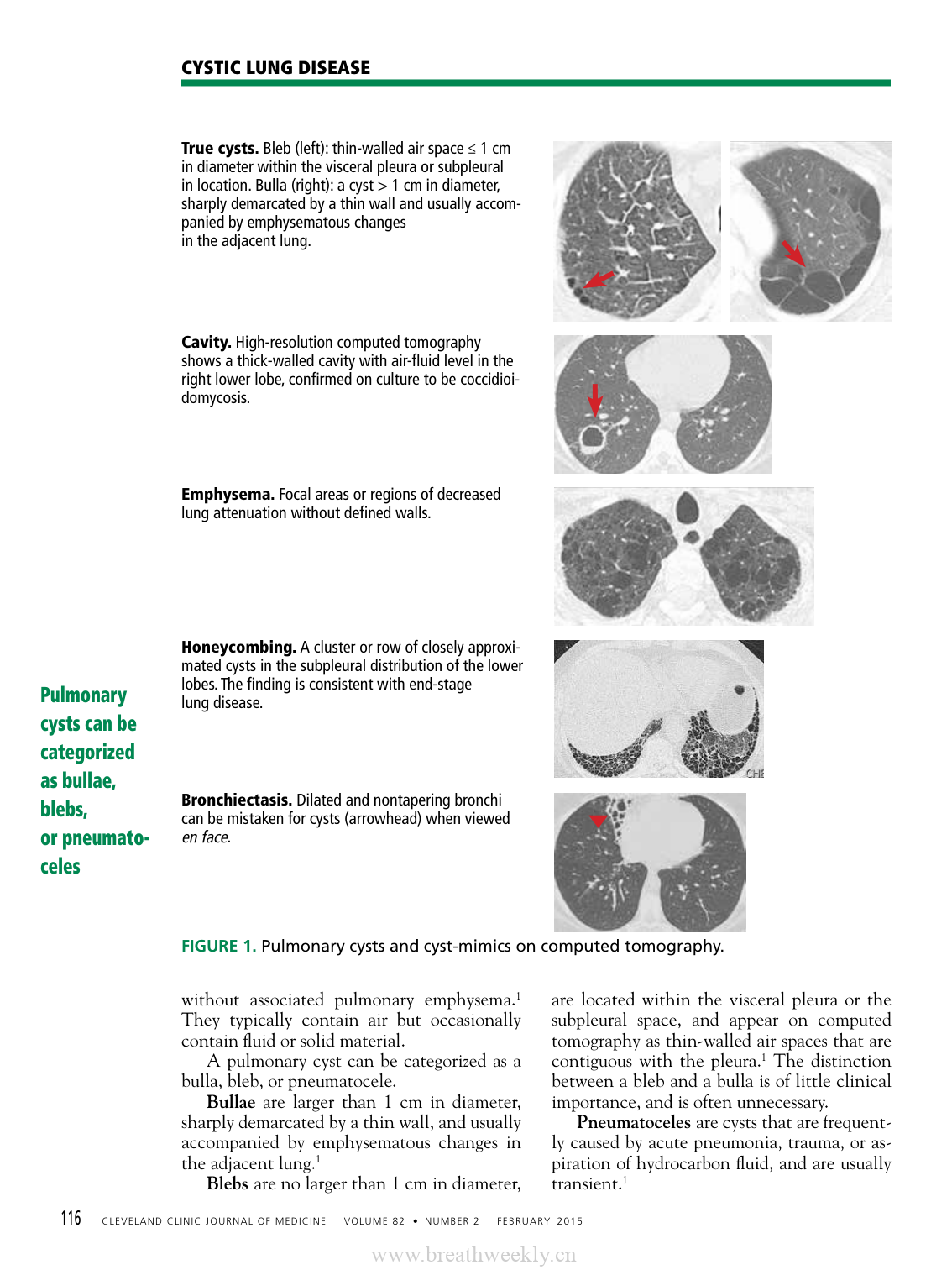囊性肺疾病的系统性诊断思路-每周呼吸