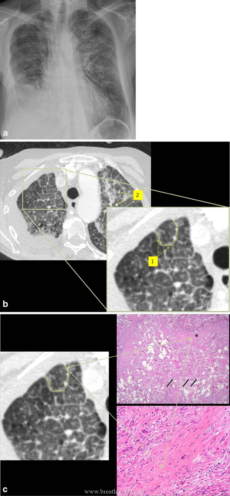 图8 癌性淋巴管炎