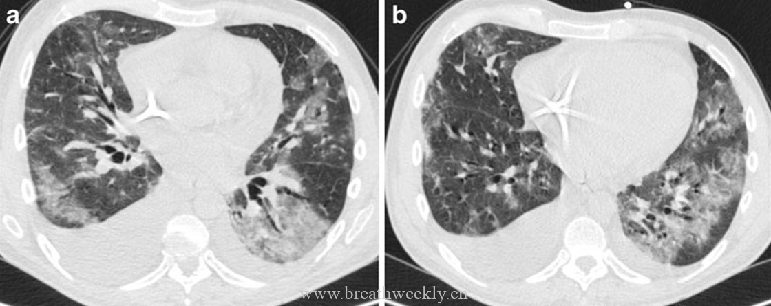 图13 移植物抗宿主病