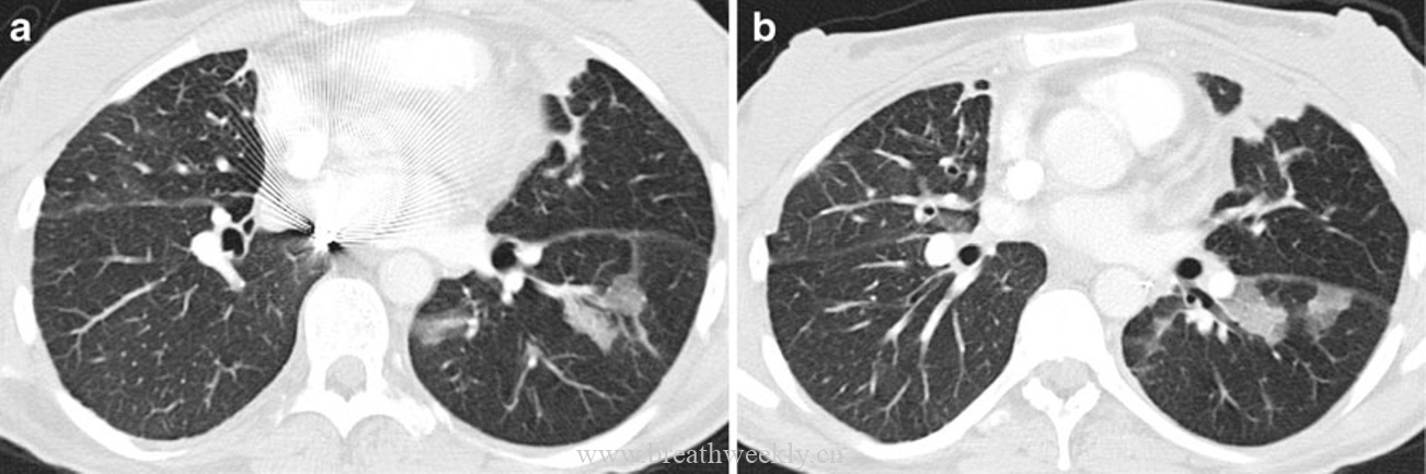 图14 机化性肺炎