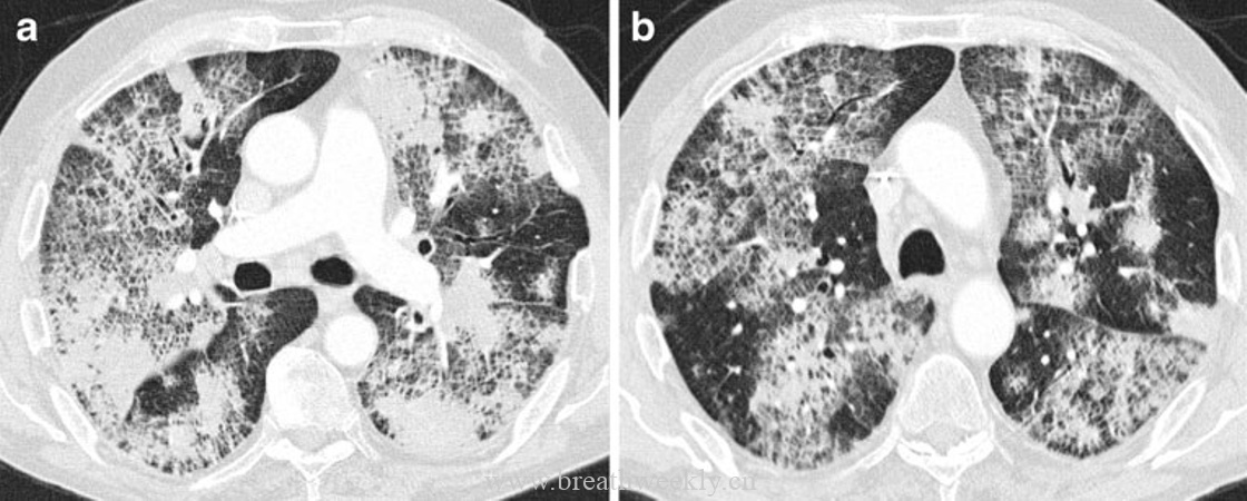图15 细支气管肺泡癌