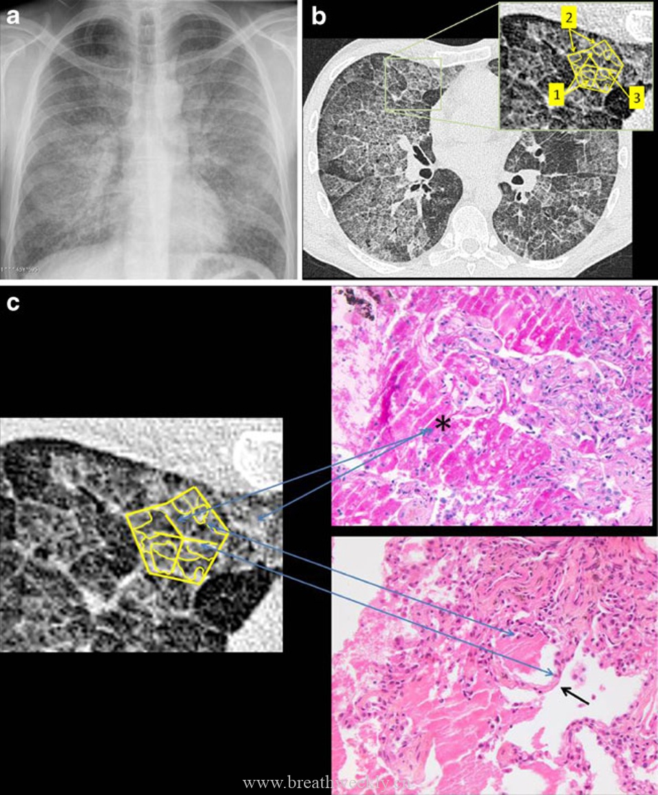 铺路石征：影像-病理对照（全文翻译）-每周呼吸