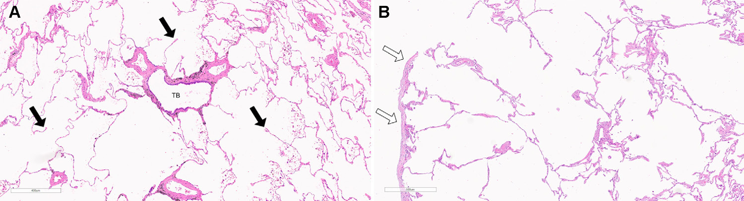 图2: smoking-related pulmonary parenchymal disease