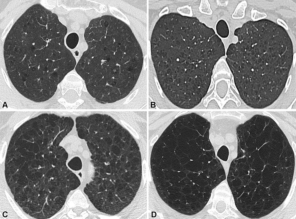 图3: smoking-related pulmonary parenchymal disease