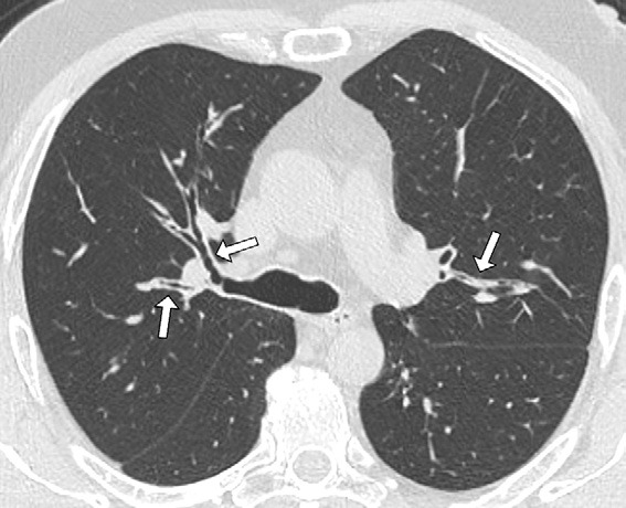 图5: smoking-related pulmonary parenchymal disease