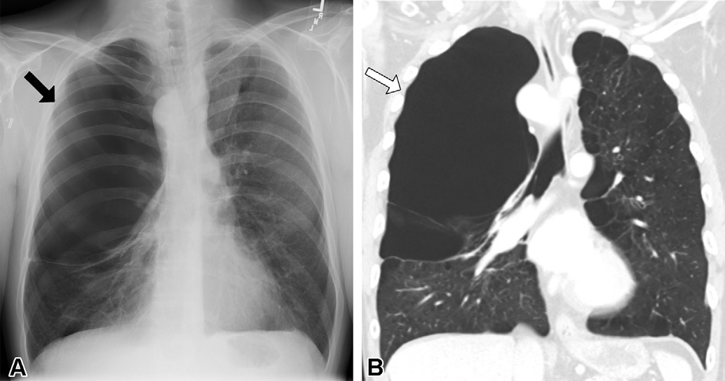 图6: smoking-related pulmonary parenchymal disease