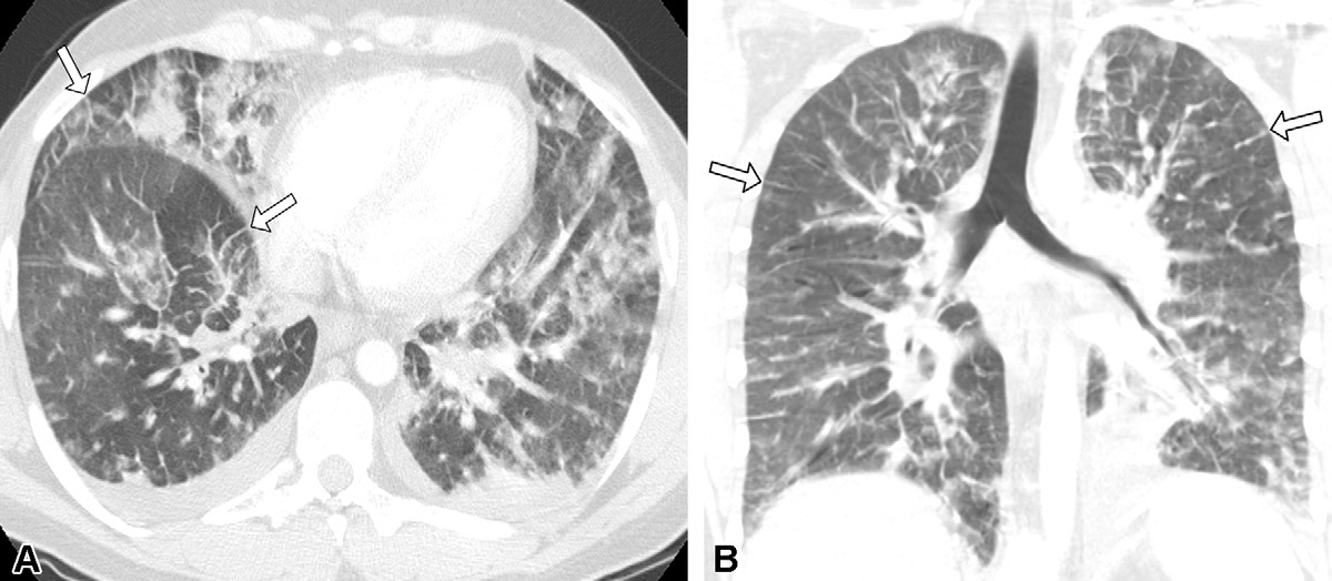 图7: smoking-related pulmonary parenchymal disease