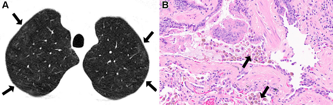 图8: smoking-related pulmonary parenchymal disease