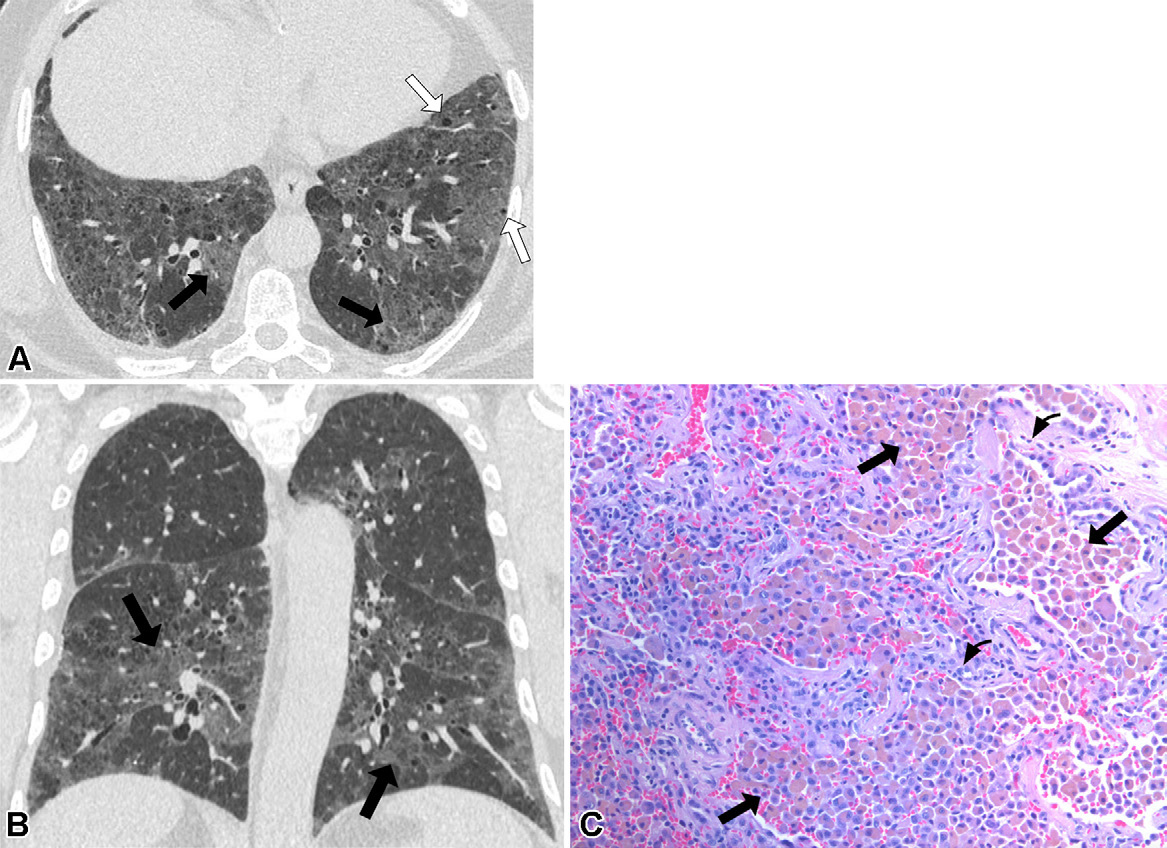 图9: smoking-related pulmonary parenchymal disease