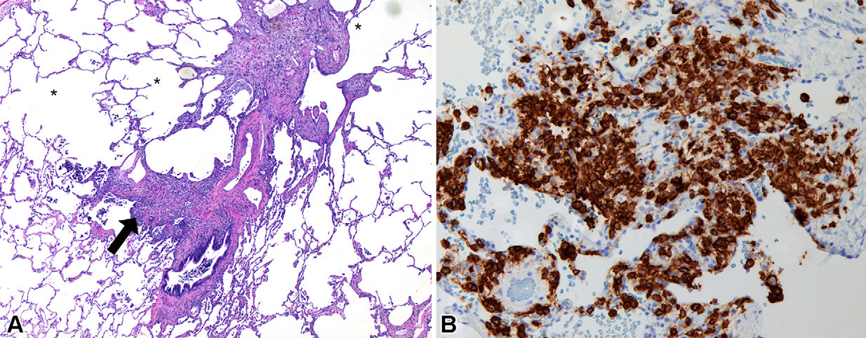 图10: smoking-related pulmonary parenchymal disease