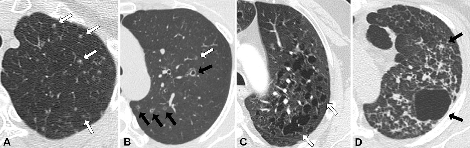 图11: smoking-related pulmonary parenchymal disease