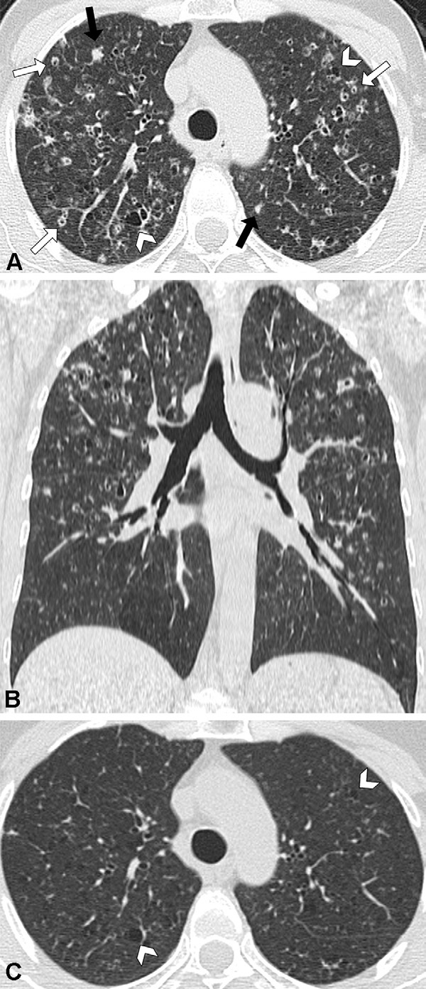 图12: smoking-related pulmonary parenchymal disease