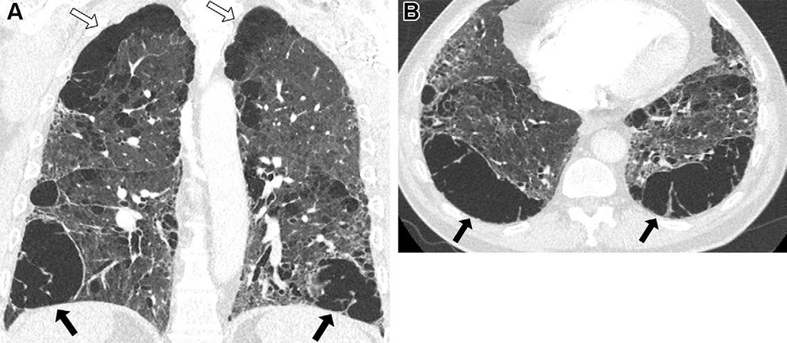 图13: smoking-related pulmonary parenchymal disease