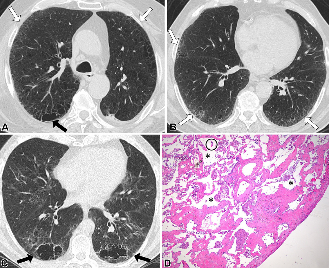 图14: smoking-related pulmonary parenchymal disease