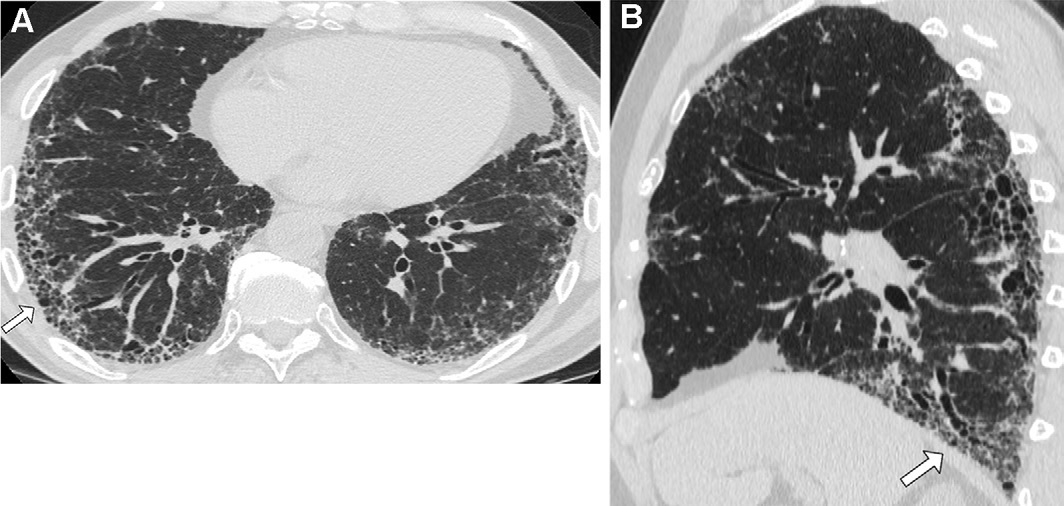 图15: smoking-related pulmonary parenchymal disease