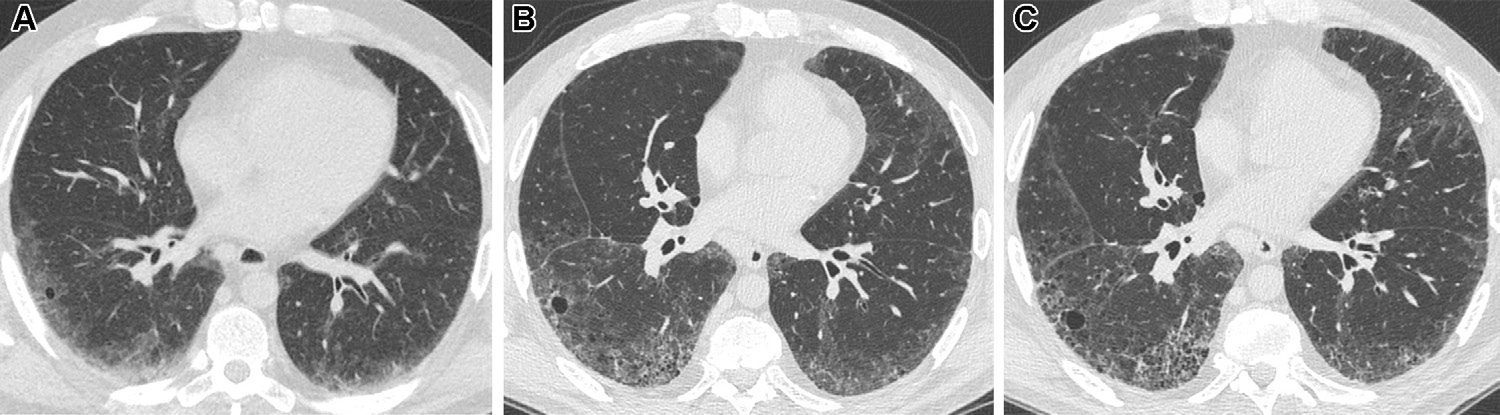 图16: smoking-related pulmonary parenchymal disease