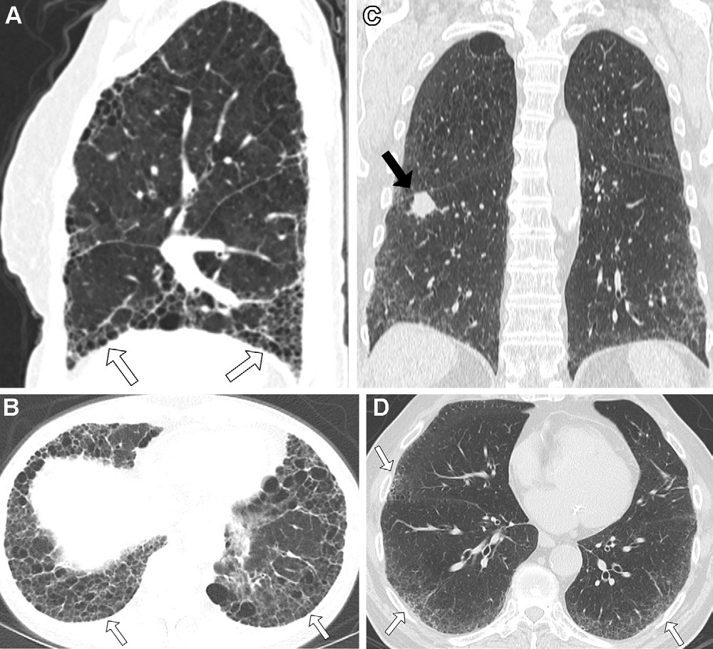 图17: smoking-related pulmonary parenchymal disease