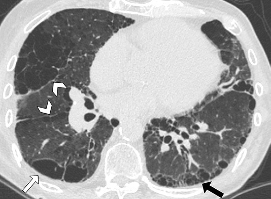 图18: smoking-related pulmonary parenchymal disease