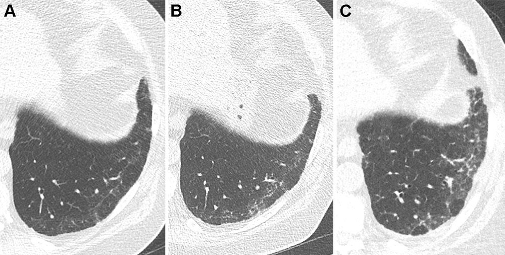 图19: smoking-related pulmonary parenchymal disease