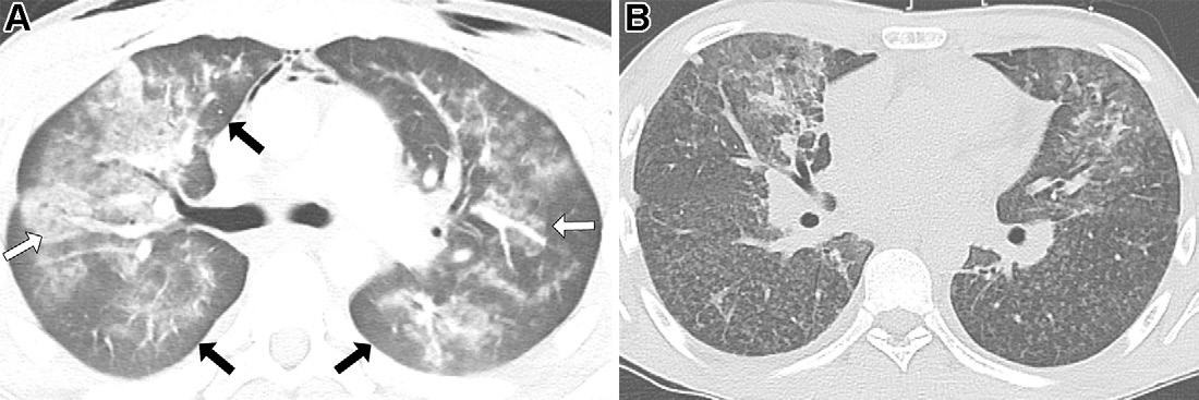 图20: smoking-related pulmonary parenchymal disease