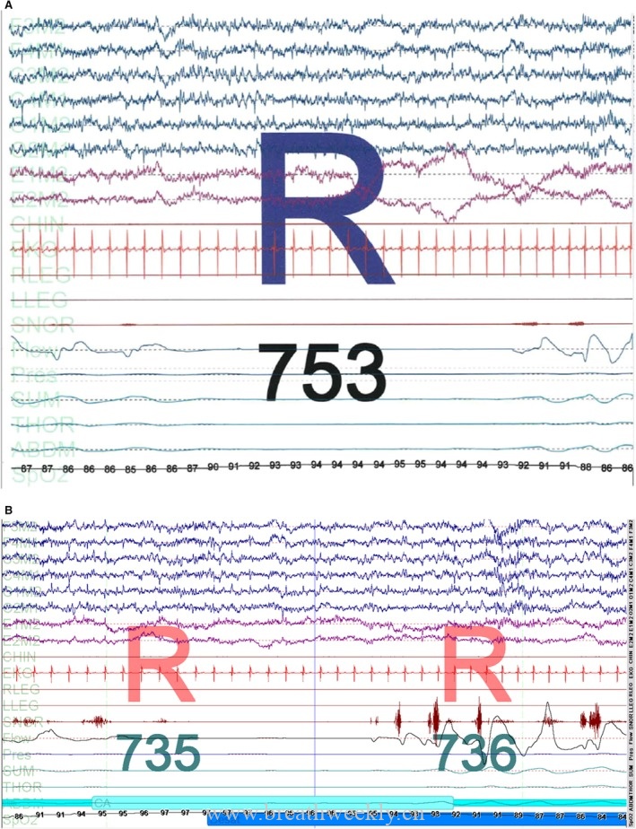 REM睡眠期为主的中枢性睡眠呼吸暂停，CPAP为何有效？-每周呼吸